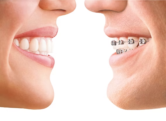 Clear Aligners for Adults: Straighten Teeth Without Braces 